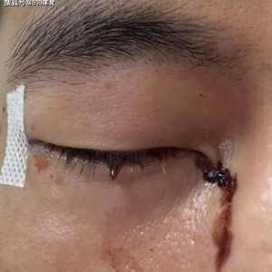惊心动魄！广东男子打板栗左眼扎入19根刺，紧急救援后险失明