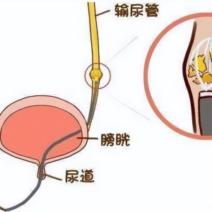 广东女子肾结石困扰，老公机智倒立法助排石