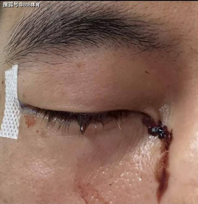 惊心动魄！广东男子打板栗左眼扎入19根刺，紧急救援后险失明