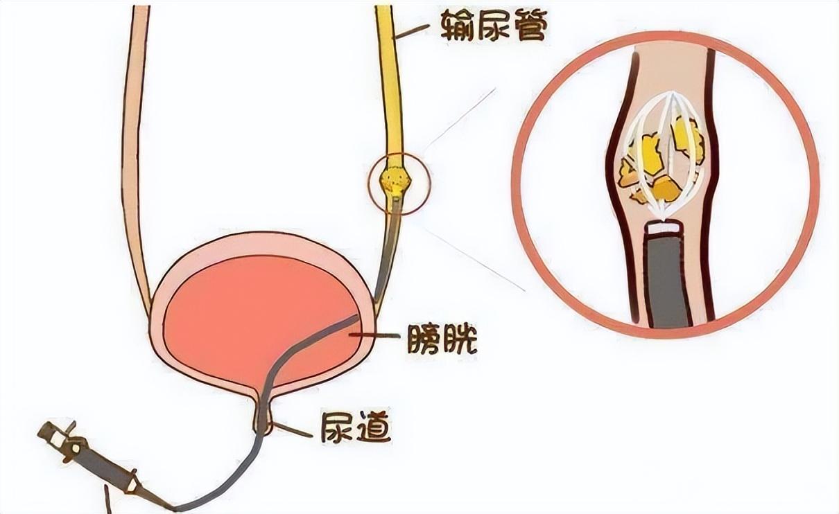 广东女子肾结石困扰，老公机智倒立法助排石